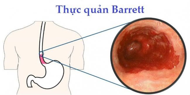 Barrett thực quản có thể dẫn tới ung thư thực quản.